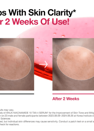 Before and after comparison of using Anua Niacinamide 10 TXA 4 Serum for skin clarity improvement.