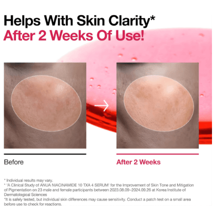 Before and after comparison of using Anua Niacinamide 10 TXA 4 Serum for skin clarity improvement.